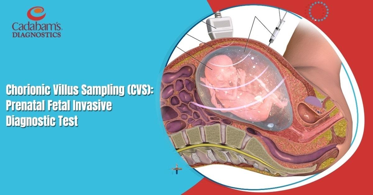 Chorionic Villus Sampling: Early Genetic Testing Explained